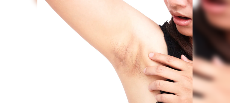 Cara Mengatasi Ketiak Gelap Secara Aman dan Efektif: Panduan Lengkap