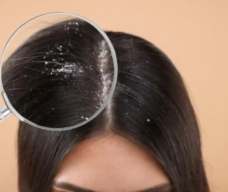 Rambut Ketombe: Bukan Hanya Soal Kebersihan, Ini Fakta Sebenarnya