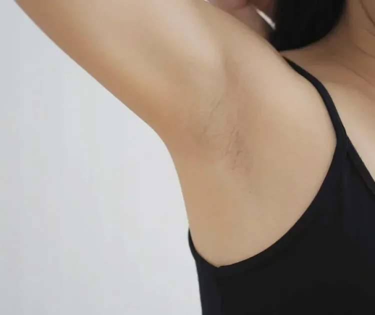 Ketiak Gelap: Penyebab, Cara Mengatasi, dan Tips Mencegahnya