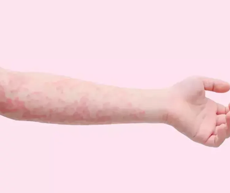 Cara Mengatasi Biduran di Malam Hari Tanpa Panik