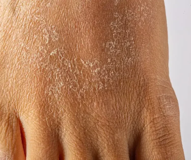 Cara Mengatasi Kulit Kering dan Bersisik Secara Tradisional