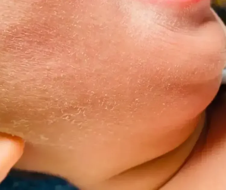 Cara Efektif Mengatasi Kulit