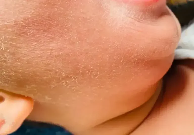 Cara Efektif Mengatasi Kulit Kering agar Tetap Lembab dan Sehat