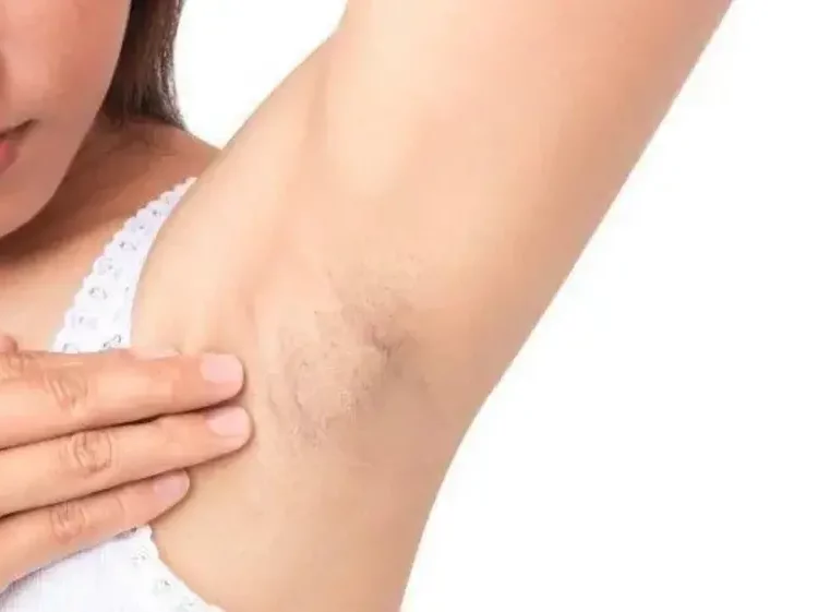 Kenapa Ketiak Hitam? Ini Penyebab yang Perlu Diketahui