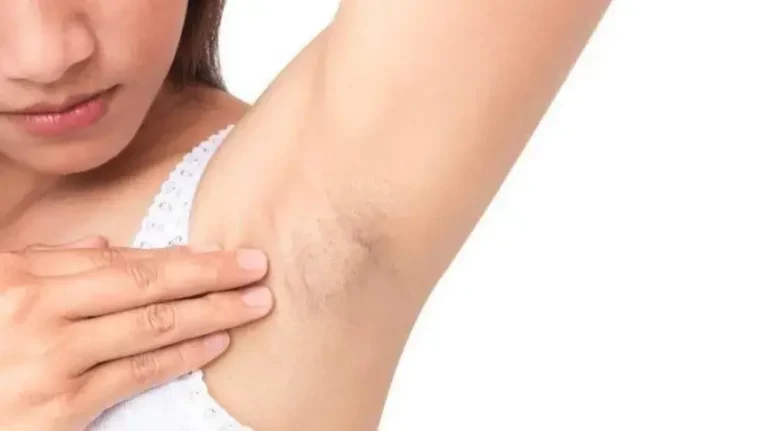 Kenapa Ketiak Hitam? Ini Penyebab yang Perlu Diketahui