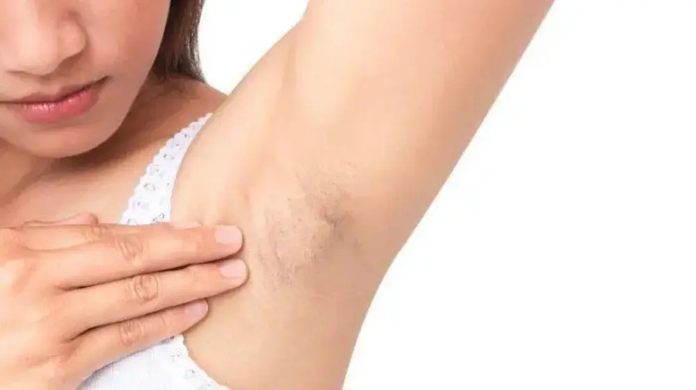 Kenapa Ketiak Hitam? Ini Penyebab yang Perlu Diketahui