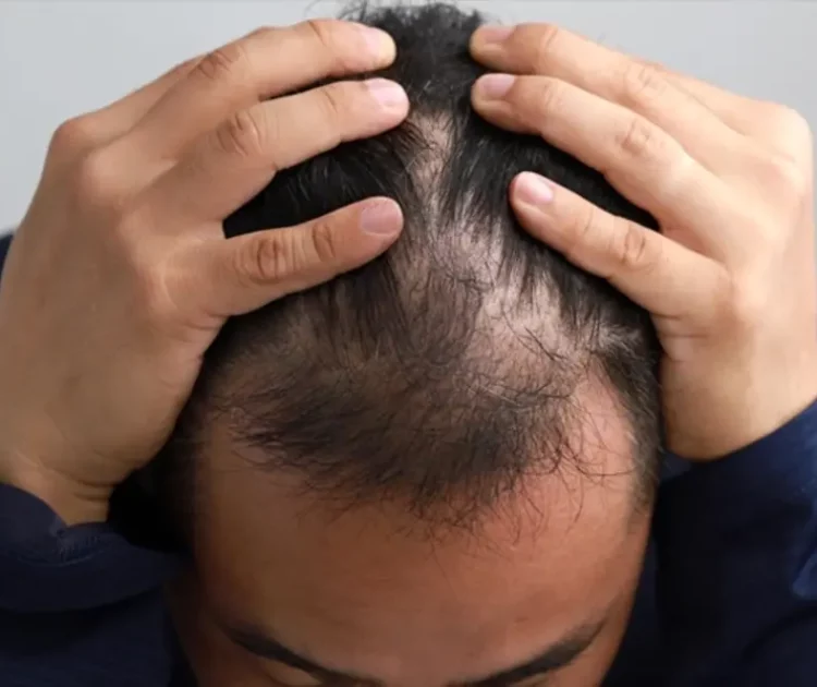 Tanda-Tanda Rambut Tipis Pria yang Sering Diabaikan