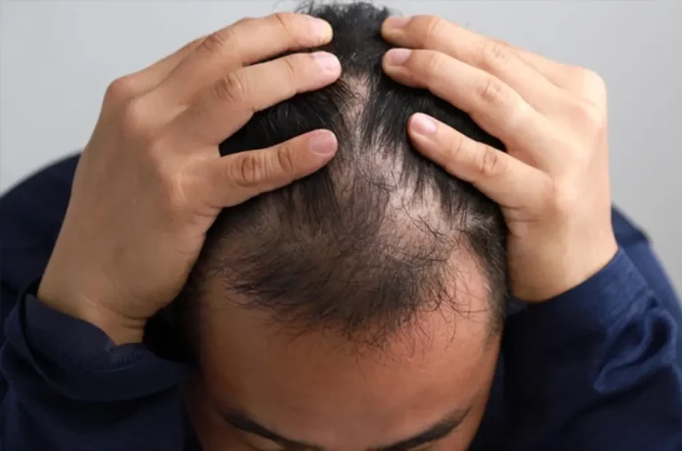 Tanda-Tanda Rambut Tipis Pria yang Sering Diabaikan