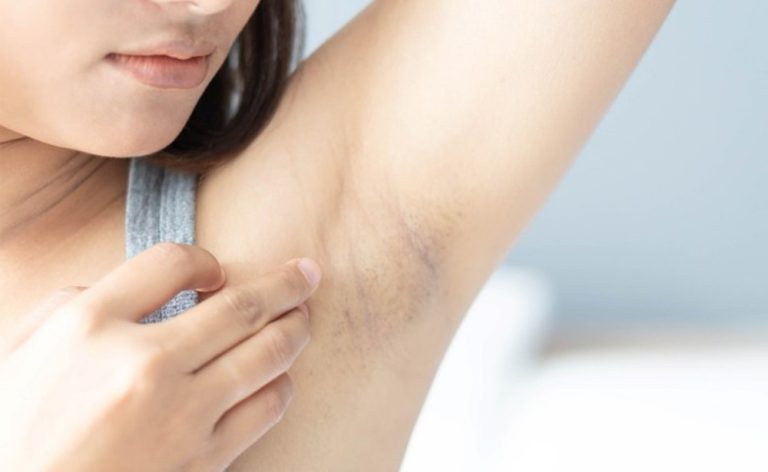 Tips Perawatan Harian Agar Ketiak Sehat dan Bersih