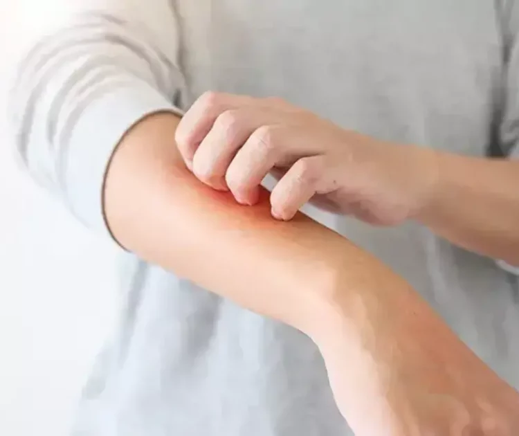 Cara Menyembuhkan Eksim Secara Total