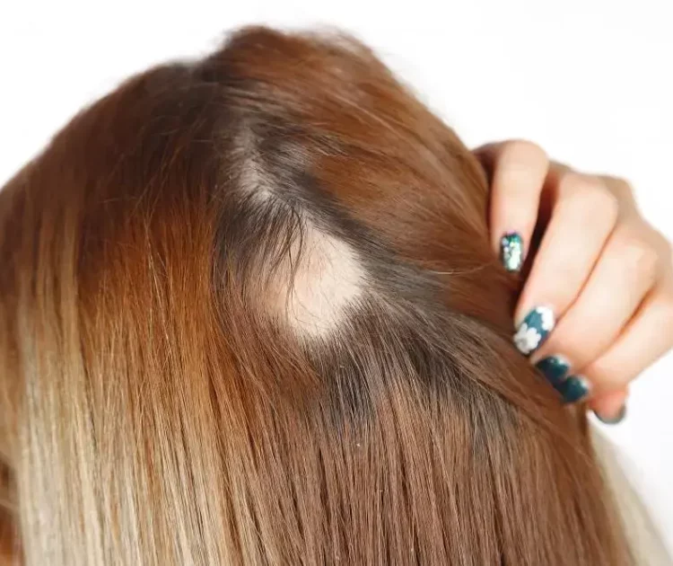 Kebotakan Berpola: Penyebab, Gejala, dan Cara Mengatasinya