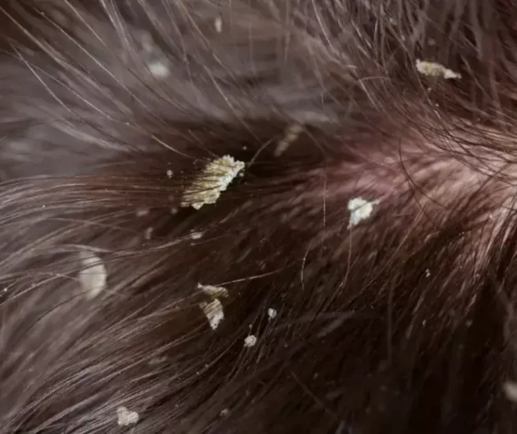 Ketombe Besar: Penyebab, Cara Mengatasi, dan Perawatan yang Tepat