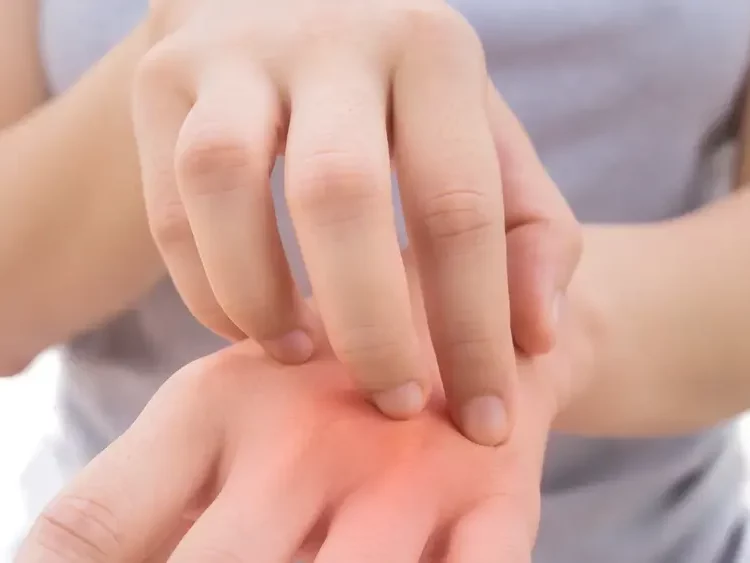 Wajib Tahu! Pertolongan Pertama Ketika Alami Iritasi Kulit