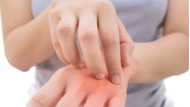 Wajib Tahu! Pertolongan Pertama Ketika Alami Iritasi Kulit