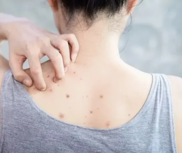 Kenapa Badan Gatal Gatal dan Cara Mengatasinya