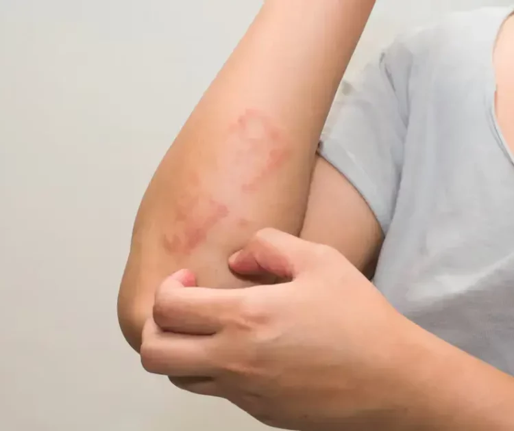 Keringat Buntet pada Orang Dewasa: Cara Menjaga Kulit Tetap Sehat