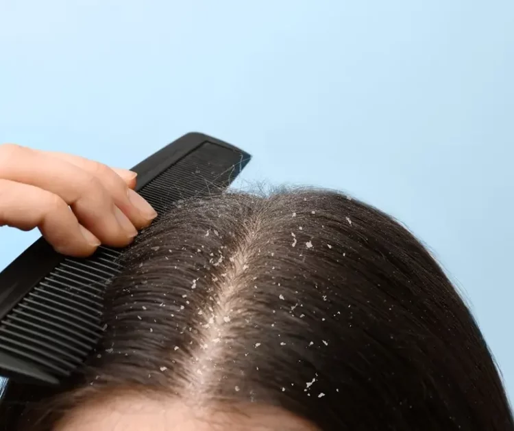 Cara Membersihkan Kulit Kepala dari Ketombe agar Rambut Tetap Sehat