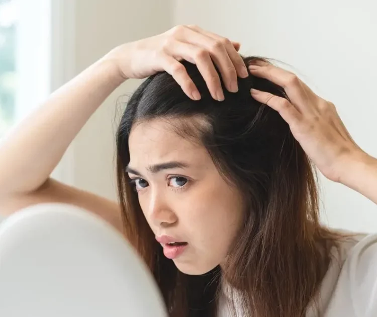 Lakukan Hal Berikut Supaya Terhindar dari Kepala Botak Di Usia Muda