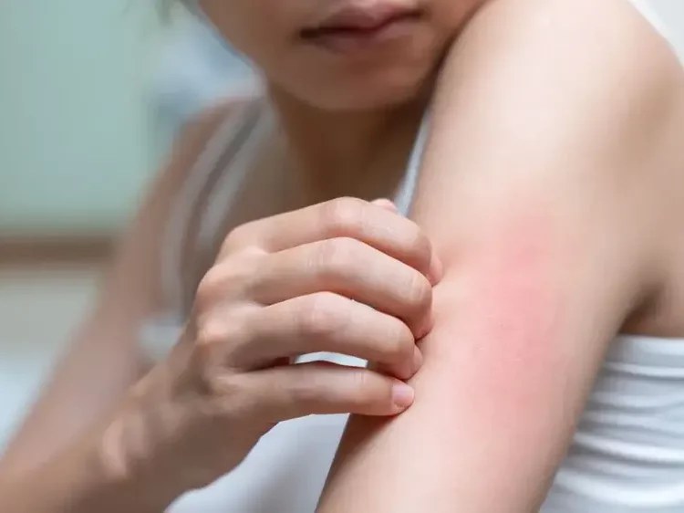 9 Cara Mudah Atasi Alergi Dingin dan Debu