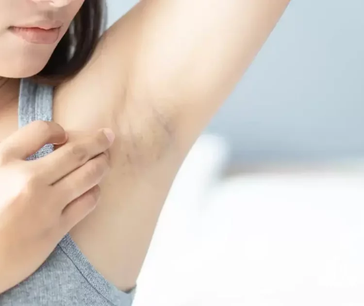 Cara Mencegah Ketiak Hitam Kembali Setelah Cerah