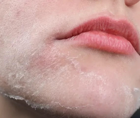 Bye Kulit Kering! Tips Jaga Kelembapan Optimal