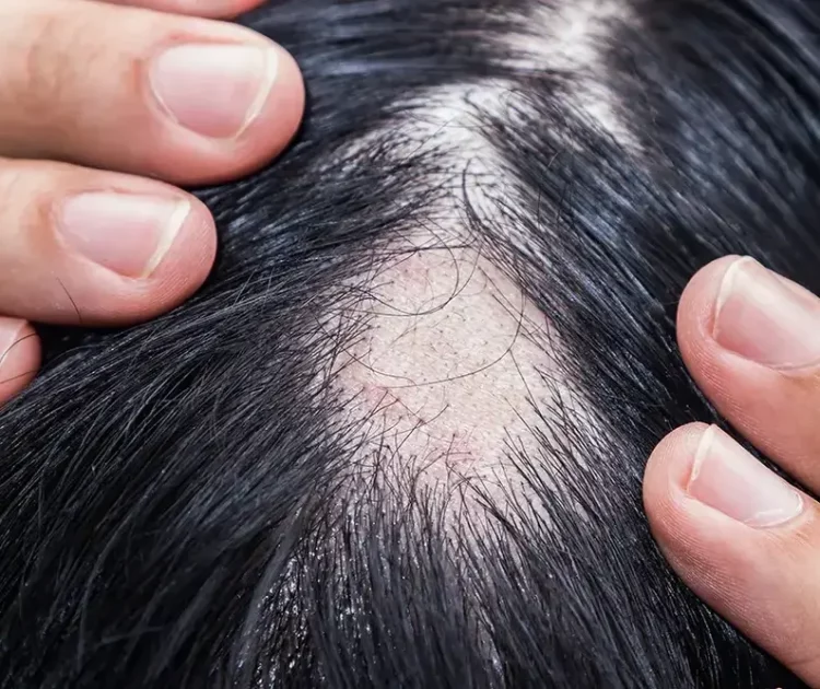 Penyakit Alopecia: Penyebab, Gejala, dan Cara Mengatasinya