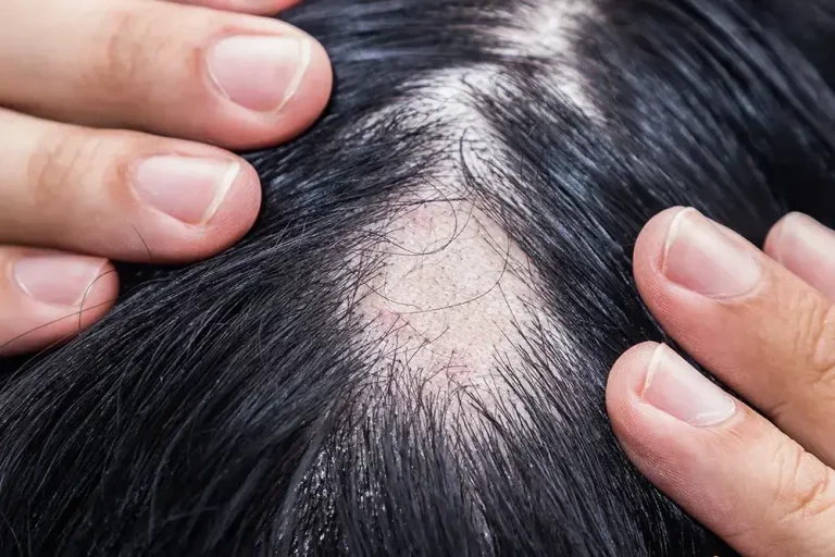 Penyakit Alopecia: Penyebab, Gejala, dan Cara Mengatasinya