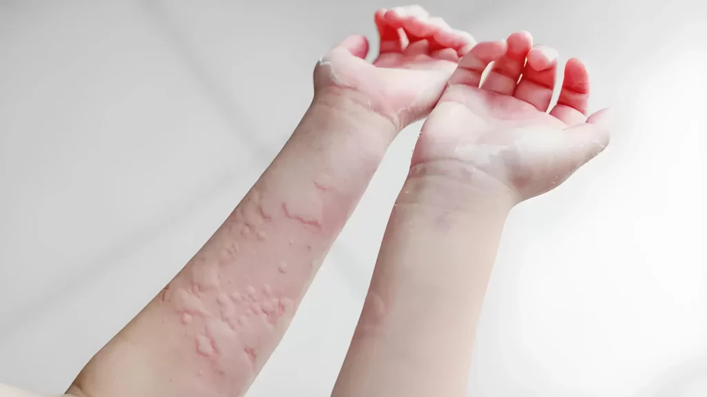 Kenapa Biduran Setiap Hari? Ini Penyebab dan Cara Mengatasinya