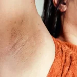 Ketiak Kering dan Bersisik: Penyebab dan Solusi Terbaik