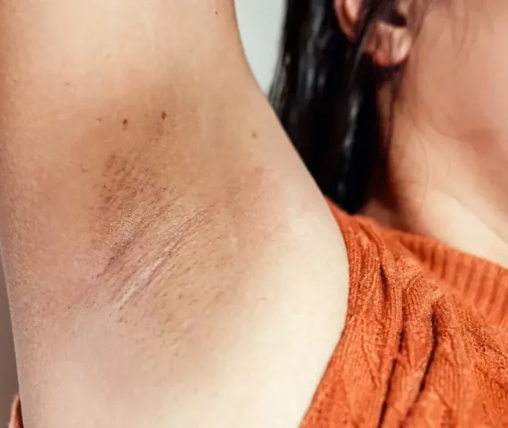 Ketiak Kering dan Bersisik: Penyebab dan Solusi Terbaik