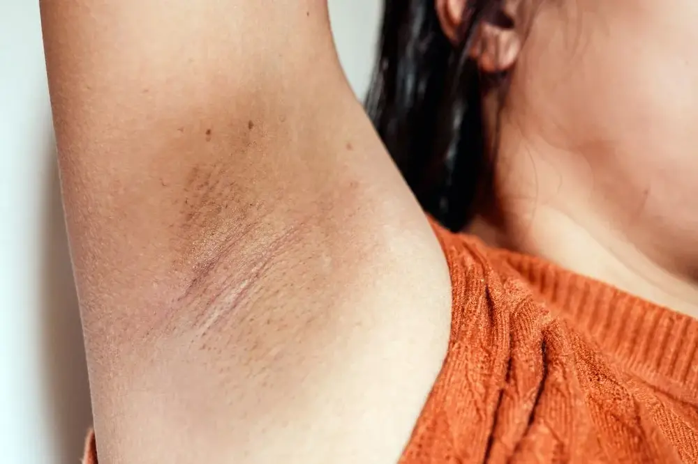 Ketiak Kering dan Bersisik: Penyebab dan Solusi Terbaik